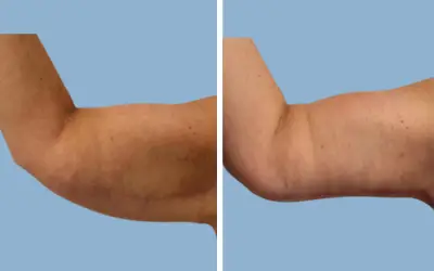 Before and After